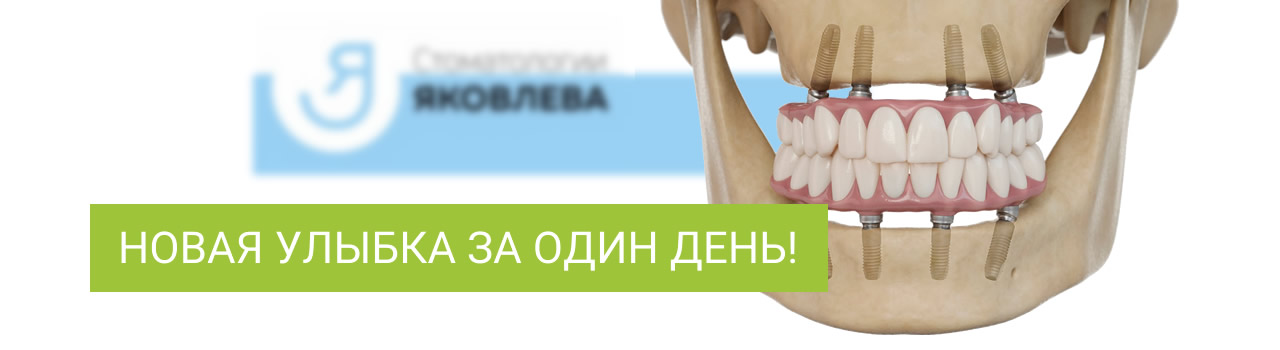 Имплантация зубов «Всё на 4-х» и «Всё на 6-и»